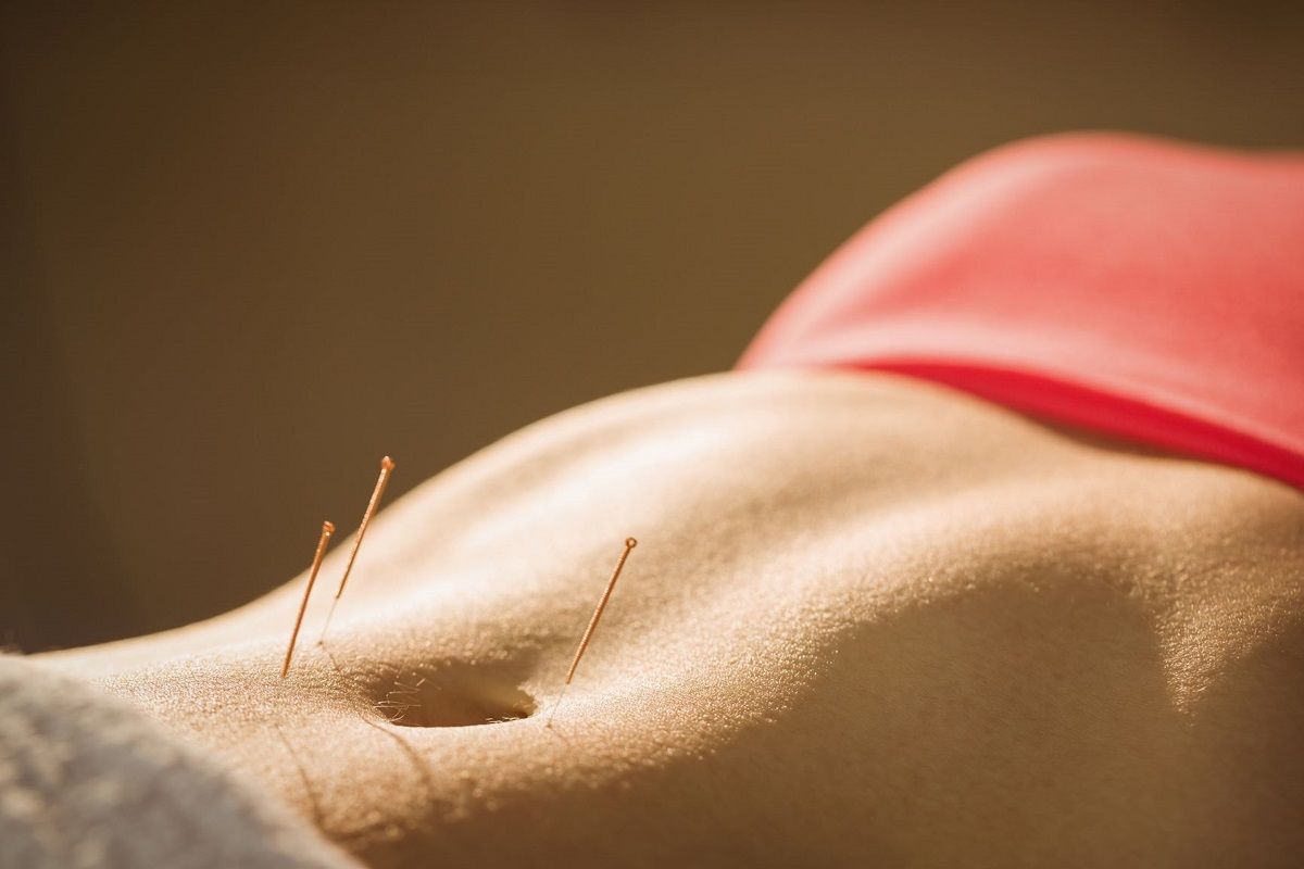 Acupuncture needles on a person's stomach